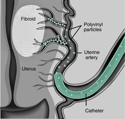 Uterine Artery Embolization